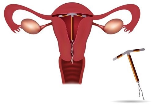 Trước đi đặt vòng có được quan hệ không? là thắc mắc của nhiều người.