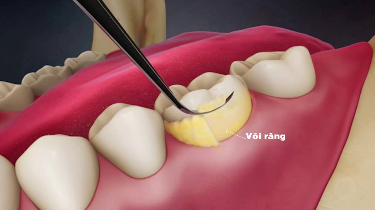 Bệnh viêm nha chu có thể gây ra những biến chứng nào?
