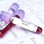 Xét nghiệm máu có phát hiện ung thư vú không?