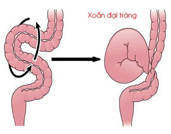 Xoắn ruột non: Nguyên nhân, triệu chứng và cách điều trị