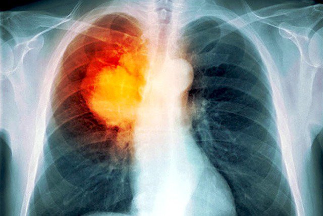 Những nguyên nhân gây phổi lủng lỗ là gì? 

