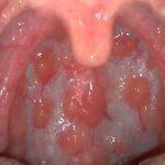 Bệnh viêm họng hạt là gì? bệnh lý khó chữa