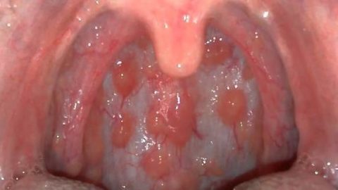 Bệnh viêm họng hạt là gì? bệnh lý khó chữa