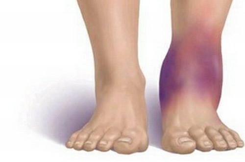 Bong gân mắt cá chân có thể gây ra bầm tím không?
