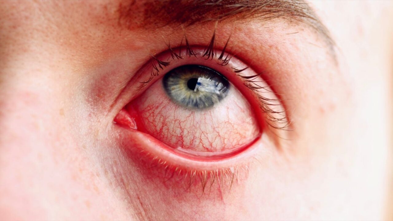 Cách phòng ngừa để tránh bị mắc bệnh đau mắt đỏ là gì?
