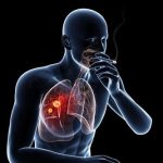 Vì sao hút thuốc lá gây ung thư phổi?