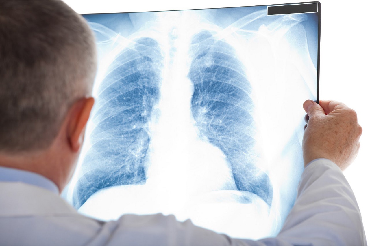 Viêm phổi viêm phổi kẽ giai đoạn cuối và những biểu hiện cần lưu ý