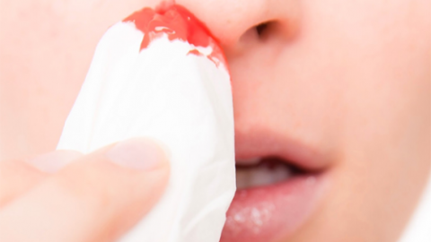 Chảy máu mũi – từ bệnh lý thông thường đến ung thư