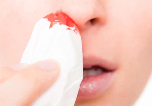 Chảy máu mũi trở nên nguy hiểm khi nào? 

