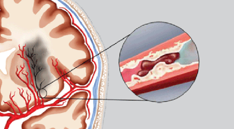 Các triệu chứng điển hình của chảy máu não là gì?
