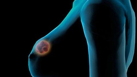 Dấu hiệu cảnh báo ung thư vú nữ giới nhất định không