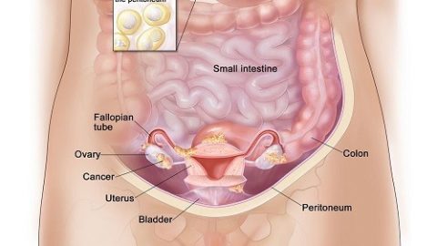 Ung thư buồng trứng giai đoạn III