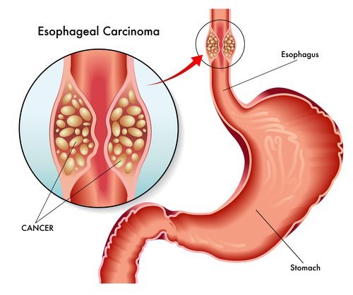 Cách điều trị khác nhau áp dụng cho từng giai đoạn của ung thư dạ dày là gì?