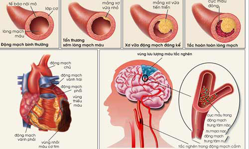 Điều trị xuất huyết não bằng cách nào và hiệu quả đến đâu luôn là vấn đề nhiều người muốn tìm hiểu.