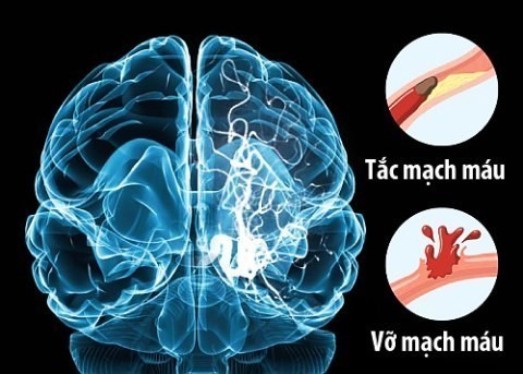 Tỷ lệ người bị xuất huyết não tại Việt Nam và các nước châu Á thường cao hơn so với các nước phương tây.
