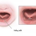 Hình ảnh dính thắng lưỡi ở trẻ: Biết để điều trị sớm