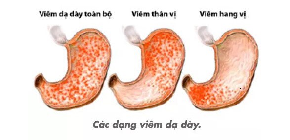 Triệu chứng chính của viêm xung huyết hang vị là gì?
