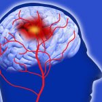 Cách điều trị xuất huyết não bằng cách nào và hiệu quả