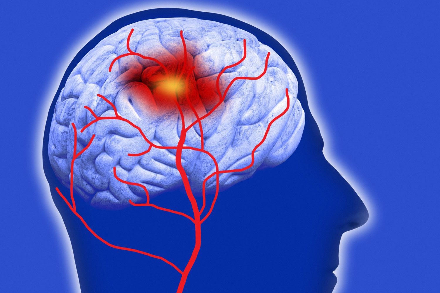 Các biến chứng có thể xảy ra trong quá trình điều trị xuất huyết não?
