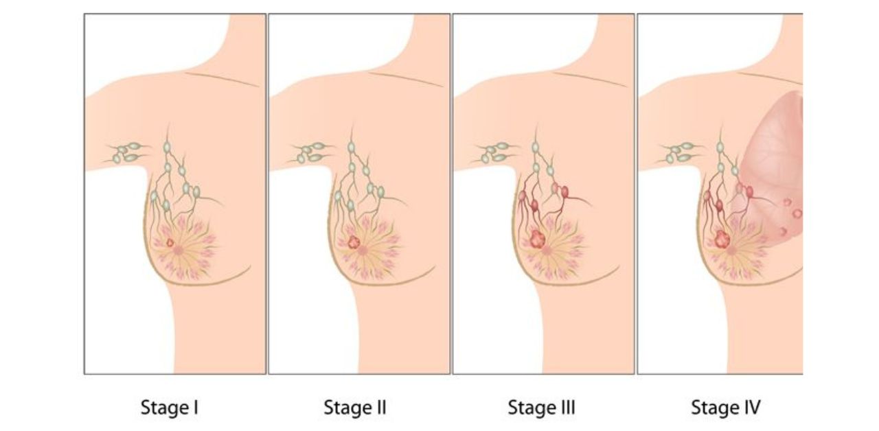 Có những biện pháp điều trị nào cho khối u ở ngực bị đau?
