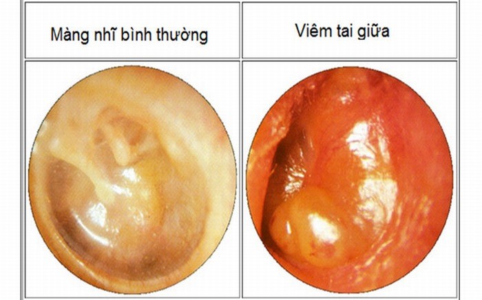 Phương pháp điều trị nào thường được sử dụng để điều trị viêm tai giữa ở người lớn?
