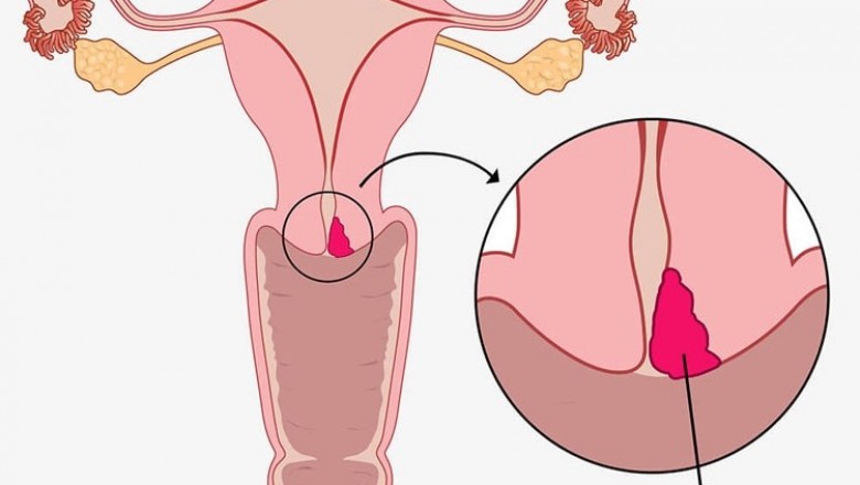 4. Phương pháp điều trị khí hư màu hồng nhạt có mùi hôi