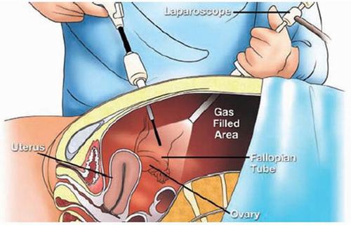 Các biến chứng hay nguy cơ liên quan đến nội soi ổ bụng là những gì cần quan tâm?
