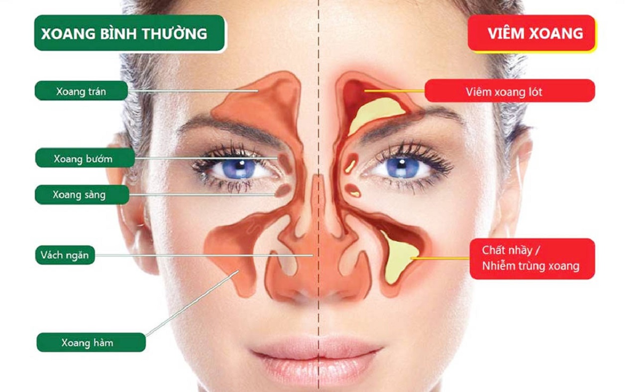 Cách phòng tránh viêm xoang và bảo vệ sức khỏe xoang mũi?
