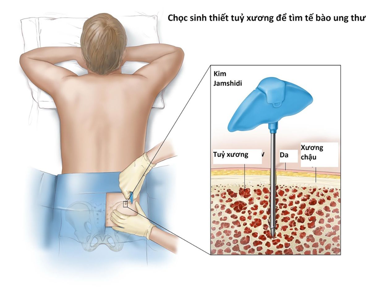 4. Tại sao cần xét nghiệm sinh thiết?