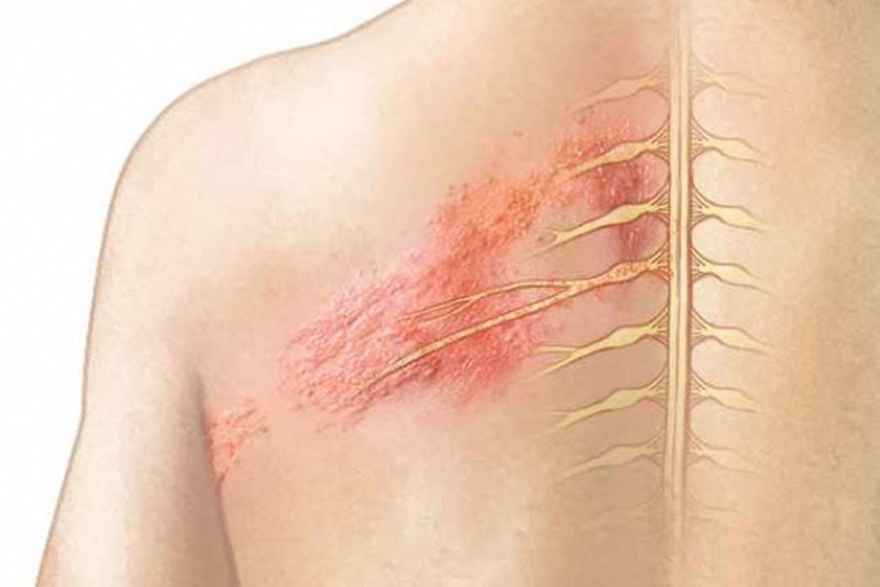 Thông tin về bệnh zona ngoài da có lây không phổ biến và cách phòng tránh hiệu quả