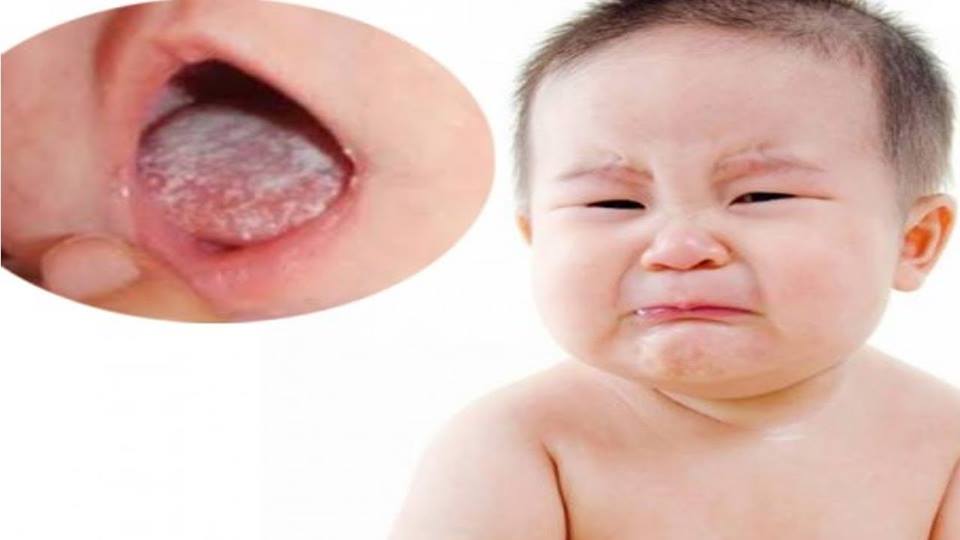 Bệnh nấm lưỡi ở trẻ em: nguyên nhân và cách điều trị | TCI Hospital