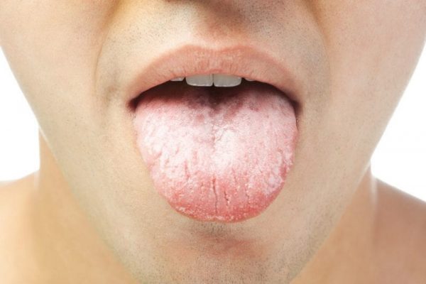 Lưỡi trắng biểu hiện một số bệnh lý mắc phải như tiểu đường, bệnh giang mai, bệnh nấm miệng, bệnh bạch sản, bệnh liken phẳng miệng hay do vệ sinh vùng miệng, lưỡi không sạch sẽ.
