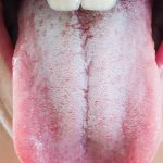 Lưỡi trắng là bệnh gì?