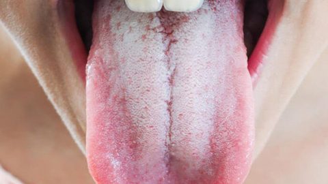 Lưỡi trắng là bệnh gì?
