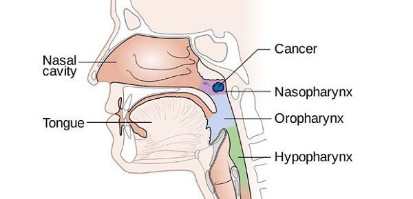 Ung thư vòm họng có chữa được không