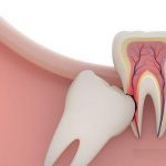 Chuyên gia giải đáp: Nhổ răng khôn có bị gì không?