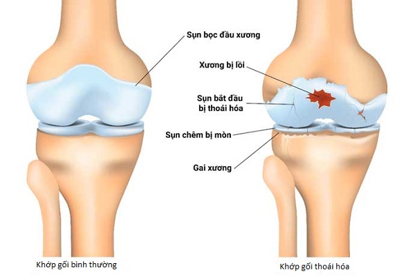 Thoái hóa khớp gối có chữa được không? | TCI Hospital