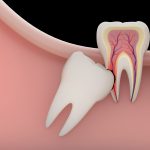 Nhổ răng khôn bao lâu thì lành? Vết thương lâu lành