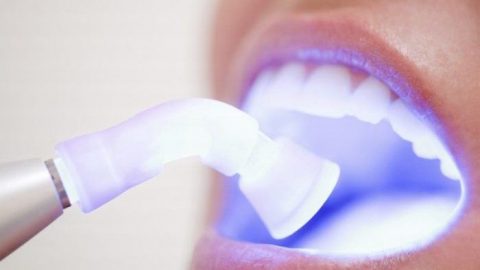 Tẩy trắng răng Plasma có hại không?