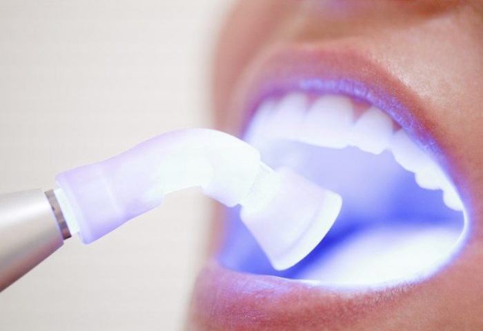 Quá trình tẩy trắng răng plasma có đảm bảo an toàn cho răng và nướu không?

