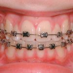Tìm hiểu về nắn chỉnh răng – Bí quyết sở hữu răng