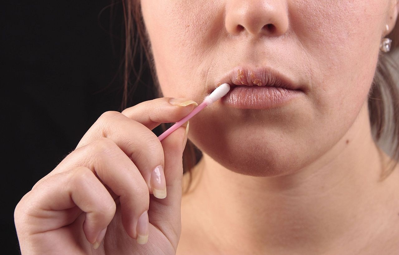 Bệnh herpes môi có thể gây ra những biến chứng gì?
