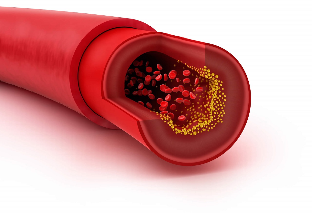 Tìm hiểu hàm lượng cholesterol là gì và cách giảm cholesterol hiệu quả