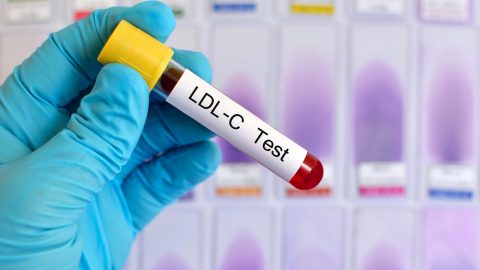 Định lượng LDL cholesterol là gì? Các yếu tố làm tăng
