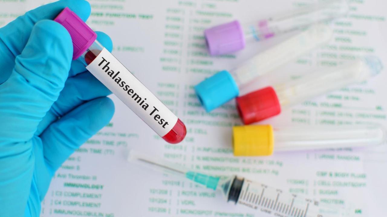 Có phương pháp phòng ngừa nào để ngăn ngừa bệnh Thalassemia không?