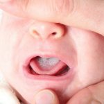 Điều trị đúng cách nấm miệng ở trẻ sơ sinh