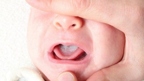 Điều trị đúng cách nấm miệng ở trẻ sơ sinh