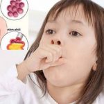 Chi tiết bệnh nhiễm khuẩn hô hấp cấp tính ở trẻ em