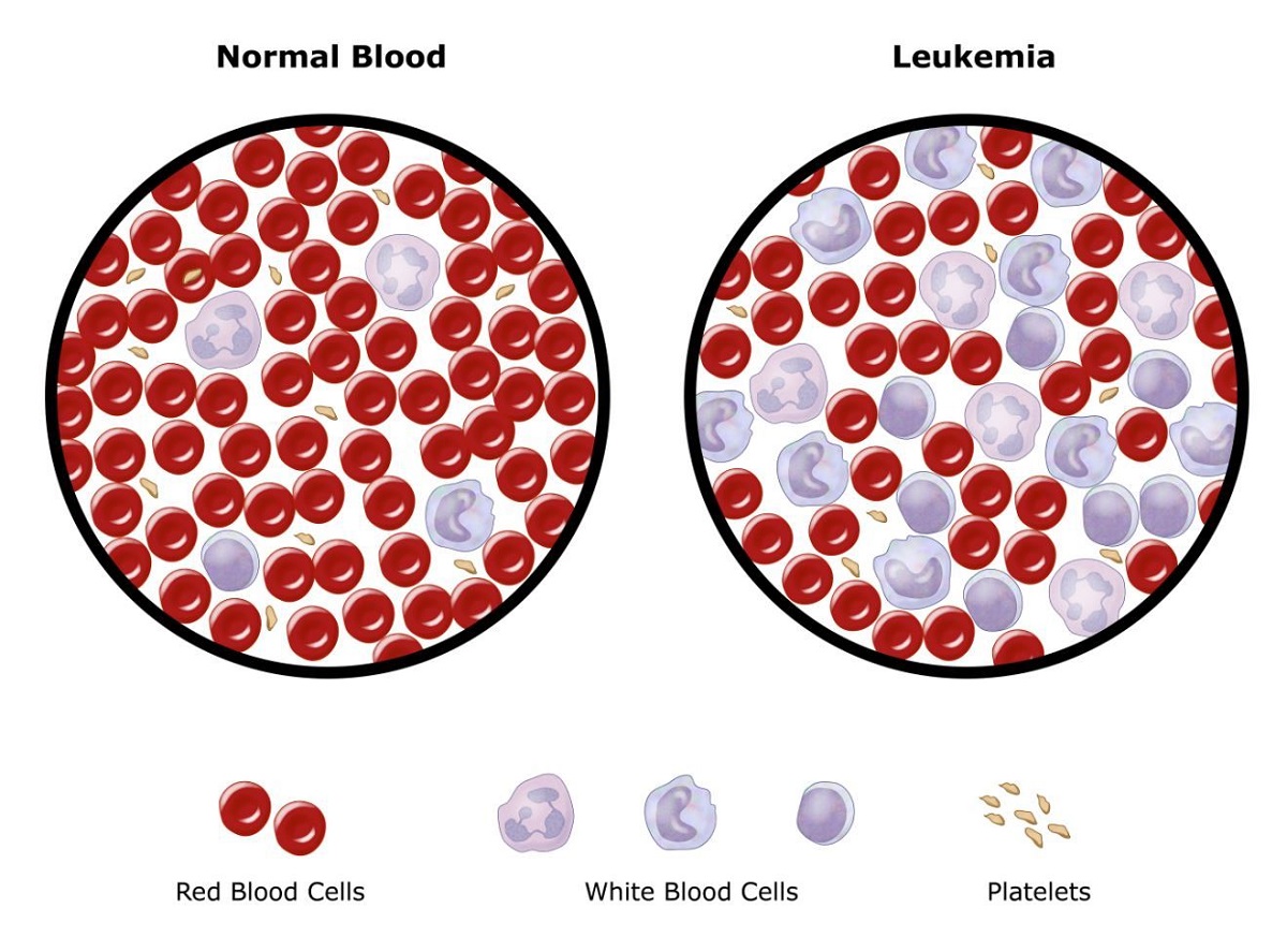 Câu hỏi và trả lời acute myeloid leukemia là gì Hướng dẫn chẩn đoán và điều trị