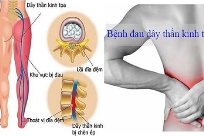 Nguyên nhân gây đau thắt lưng ở nam giới có liên quan đến vấn đề gì?